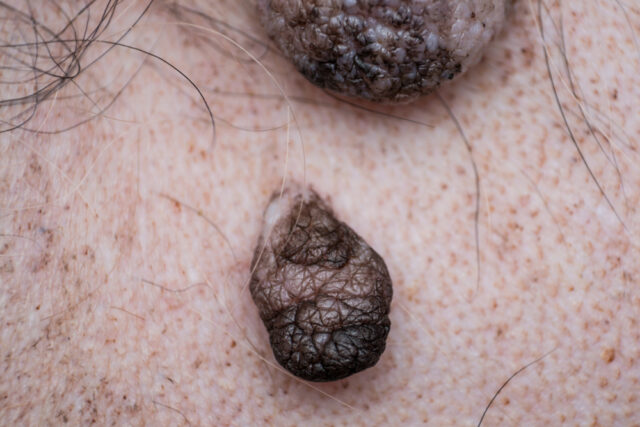 Skin,Lumps,And,Bumps,In,Dog Cancer moles on dogs - as seen on a dog's belly