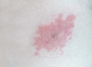 Vaccine rash on a dog Vaccine rash on a dog - possible reason of bump on a dog's private area